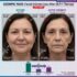 ozempic face